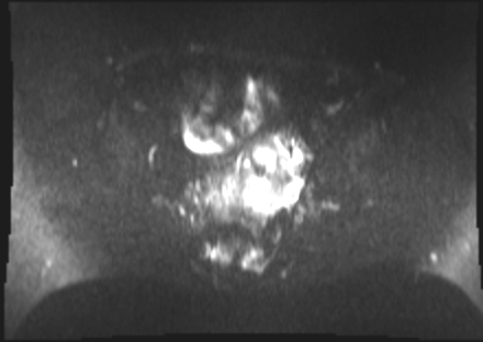 File:Cervical carcinoma (Radiopaedia 88312-104943 Axial DWI 12).jpg