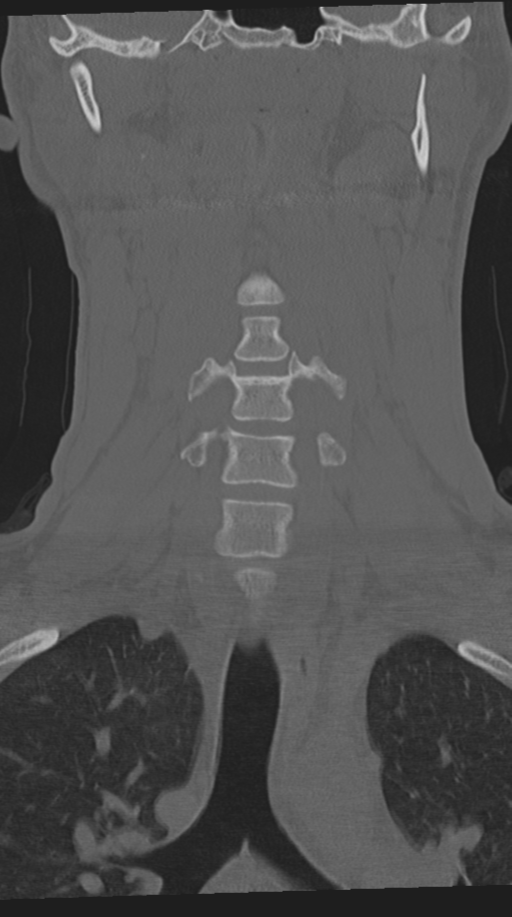 Cervical intercalary bone (Radiopaedia 35211-36748 Coronal bone window 28).png
