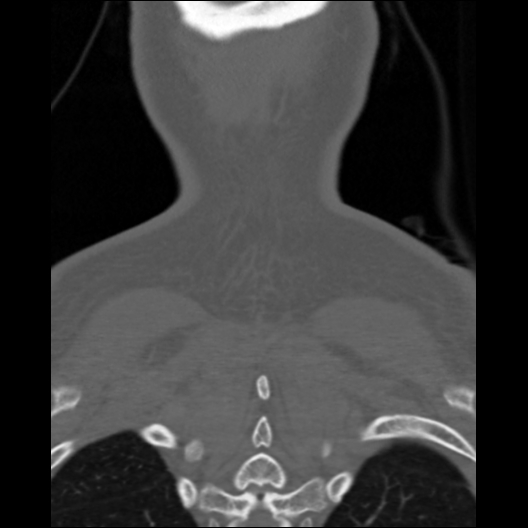 File:Cervical rib (Radiopaedia 71110-81363 Coronal non-contrast 8).jpg