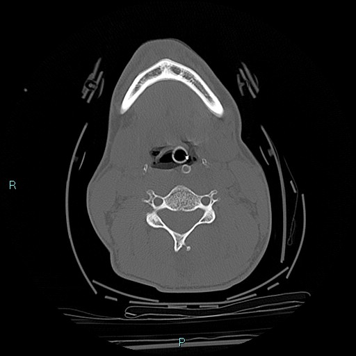 File:Cervical vertebral burst fracture (Radiopaedia 37420-39258 Axial bone window 46).jpg