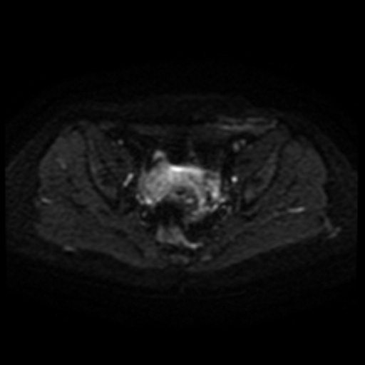 File:Cesarian section scar endometriosis (Radiopaedia 66520-75799 Axial DWI 37).jpg