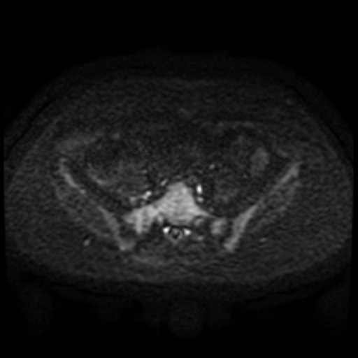 Cesarian section scar endometriosis (Radiopaedia 66520-75799 Axial DWI 77).jpg