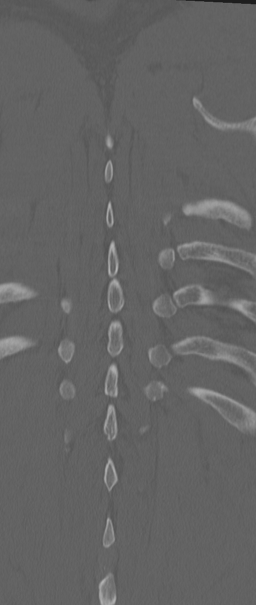 Chance fracture (Radiopaedia 33854-35020 Coronal bone window 76).png
