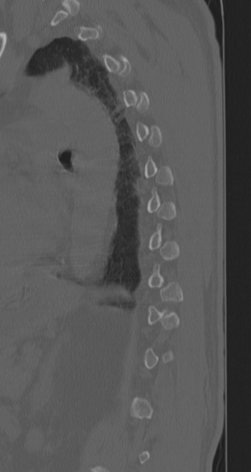 Chance fracture (Radiopaedia 33854-35020 Sagittal bone window 25).png