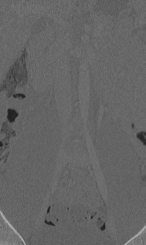 Chance fracture (Radiopaedia 40360-42912 Coronal bone window 9).png