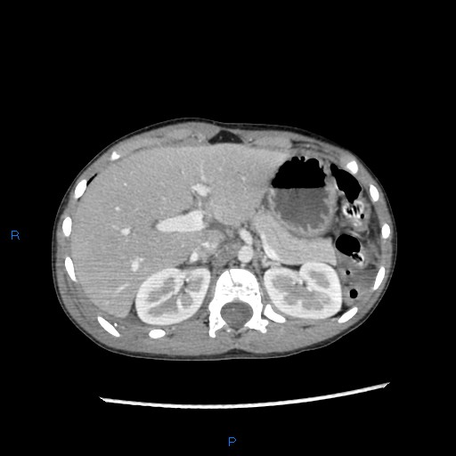 File:Chance fracture with duodenal and pancreatic lacerations (Radiopaedia 43477-46864 A 1).jpg