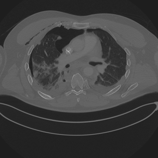 Chest multitrauma - aortic injury (Radiopaedia 34708-36147 Axial bone window 140).png