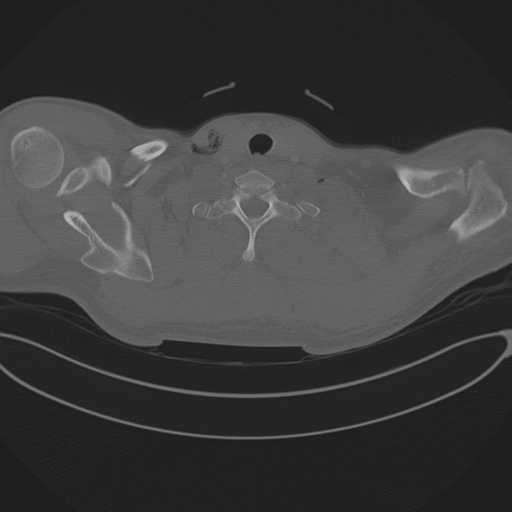 Chest multitrauma - aortic injury (Radiopaedia 34708-36147 Axial bone window 3).png