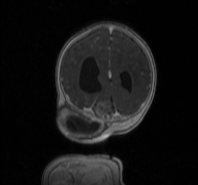 Chiari III malformation with occipital encephalocele (Radiopaedia 79446-92559 Coronal T1 C+ mpr 39).jpg