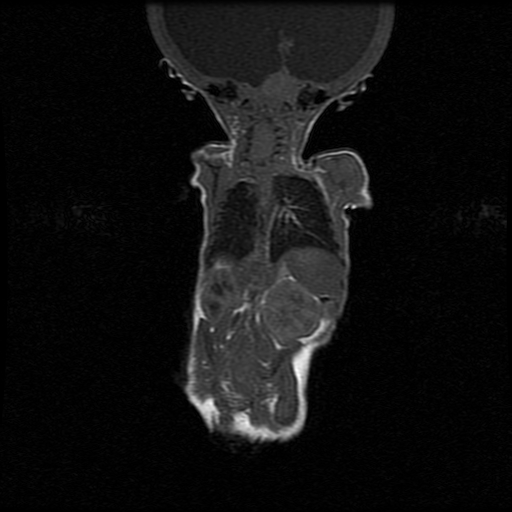 File:Chiari II malformation with spinal meningomyelocele (Radiopaedia 23550-23652 Coronal T1 4).jpg