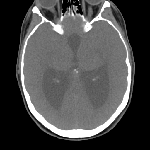 Chiari I malformation and obstructive hydrocephalus (Radiopaedia 41185-43981 D 14).png