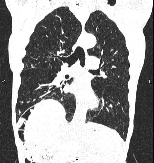 Chilaiditi sign (Radiopaedia 88839-105611 Coronal lung window 35).jpg
