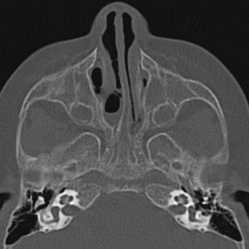 Choanal atresia (Radiopaedia 88525-105975 Axial bone window 35).jpg