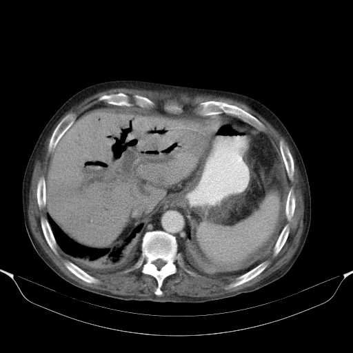 File:Cholangitis and abscess formation in a patient with cholangiocarcinoma (Radiopaedia 21194-21100 A 11).jpg