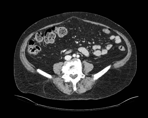 Cholecystoduodenal fistula (Radiopaedia 48959-54022 A 3).jpg
