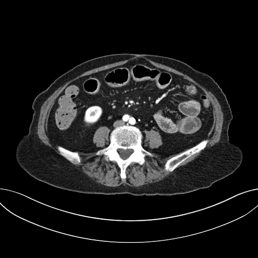 Cholecystoduodenal fistula due to calculous cholecystitis with gallstone migration (Radiopaedia 86875-103077 A 43).jpg