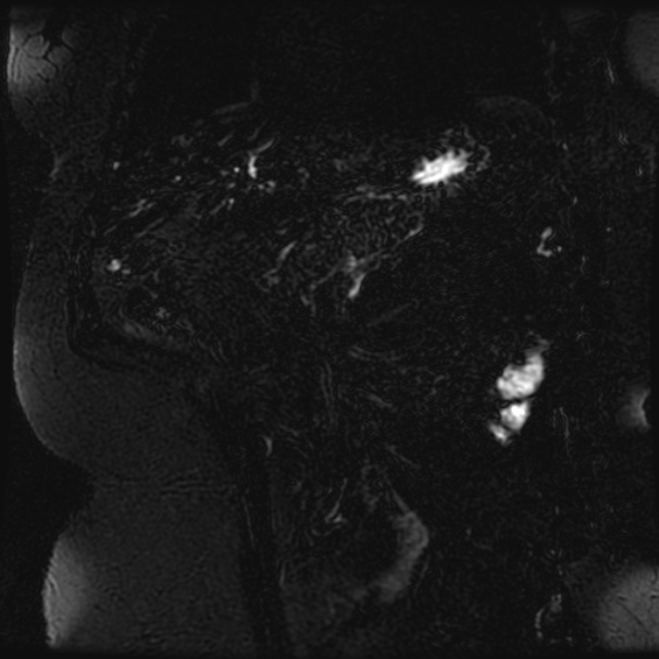 Choledocholithiasis on CT and MRI (Radiopaedia 24825-25088 Coronal T2 80).jpg