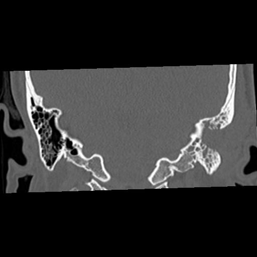 Cholesteatoma (Radiopaedia 84960-100474 Coronal bone window 45).jpg