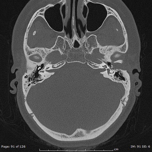 Cholesteatoma - external auditory canal (Radiopaedia 88452-105096 Axial bone window 54).jpg