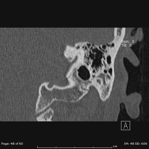 File:Cholesteatoma - external auditory canal (Radiopaedia 88452-105096 Coronal bone window 48).jpg