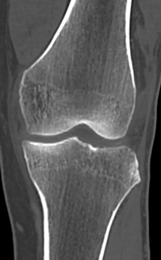 Chondrocalcinosis (Radiopaedia 82862-97173 Coronal bone window 36).jpg
