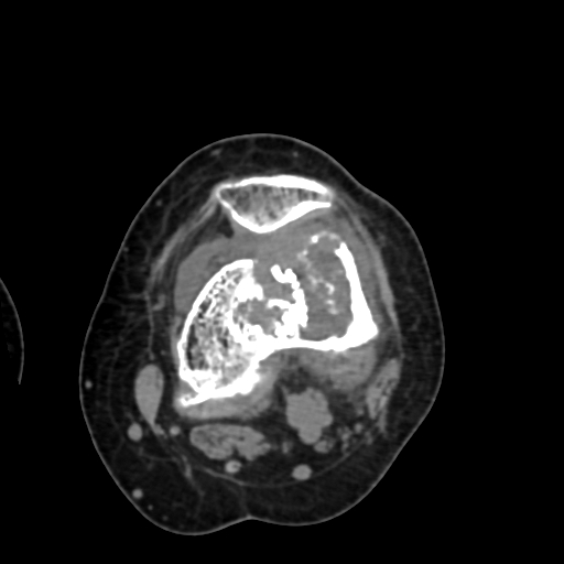 Chondrosarcoma - femur (Radiopaedia 64187-72954 Axial non-contrast 40).jpg