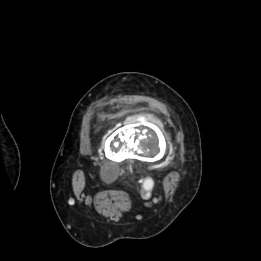 Chondrosarcoma - femur (Radiopaedia 64187-72954 Axial with contrast 31).jpg