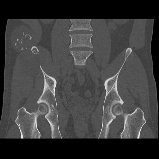 Chondrosarcoma of iliac wing (Radiopaedia 63861-72599 Coronal bone window 65).jpg