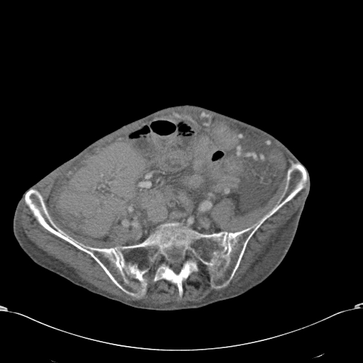 Chondrosarcoma of the spine (Radiopaedia 49871-55143 A 45).jpg