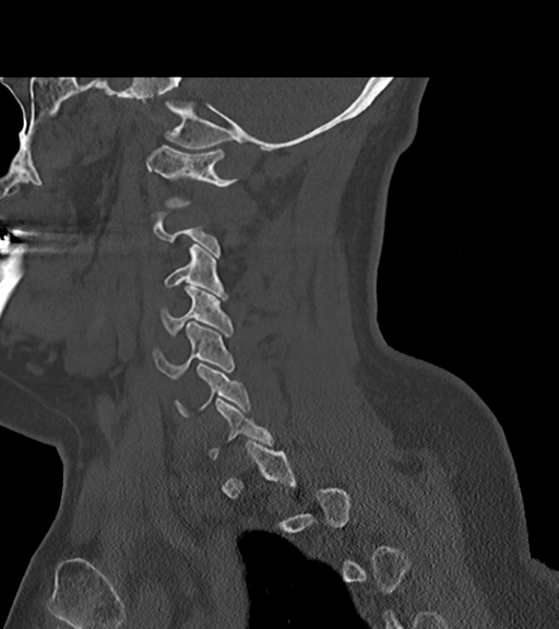 File:Chordoma (C4 vertebra) (Radiopaedia 47561-52188 Sagittal bone window 25).png