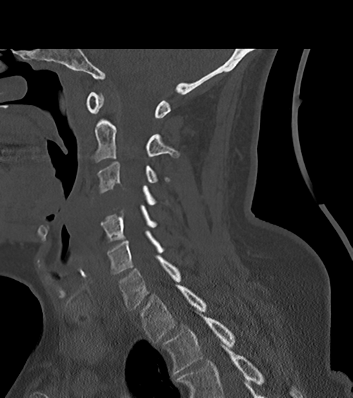 File:Chordoma (C4 vertebra) (Radiopaedia 47561-52188 Sagittal bone window 45).png