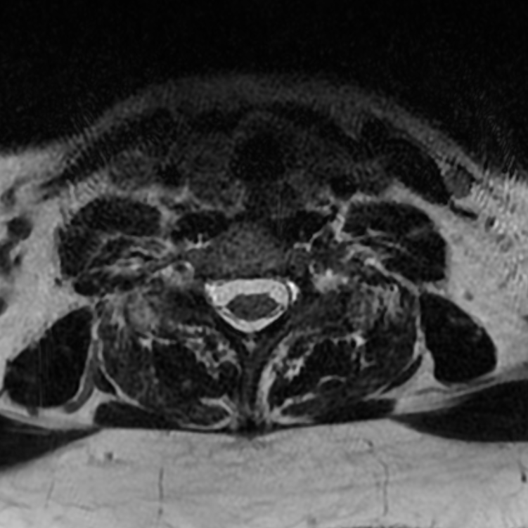 Chordoma - cervical spine (Radiopaedia 70084-80111 Axial T2 73).png