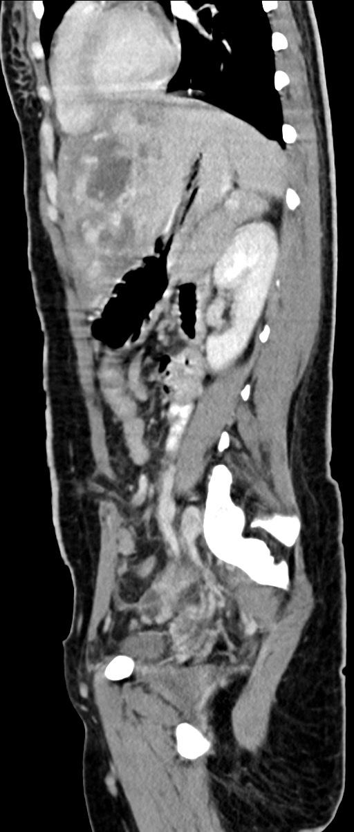 Choriocarcinoma liver metastases (Radiopaedia 74768-85766 C 78).jpg