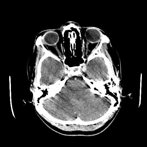 File:Choriocarcinoma of ovary with cerebral and pulmonary metastases (Radiopaedia 25983-26118 C+ arterial phase 35).jpg
