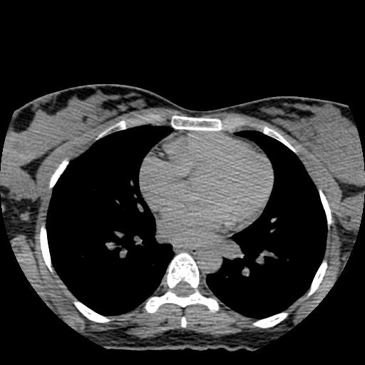 File:Choriocarcinoma of ovary with cerebral and pulmonary metastases (Radiopaedia 25983-26119 Axial non-contrast 148).jpg