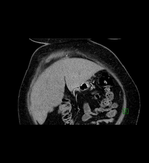 Chromophobe renal cell carcinoma (Radiopaedia 84239-99519 C 17).jpg