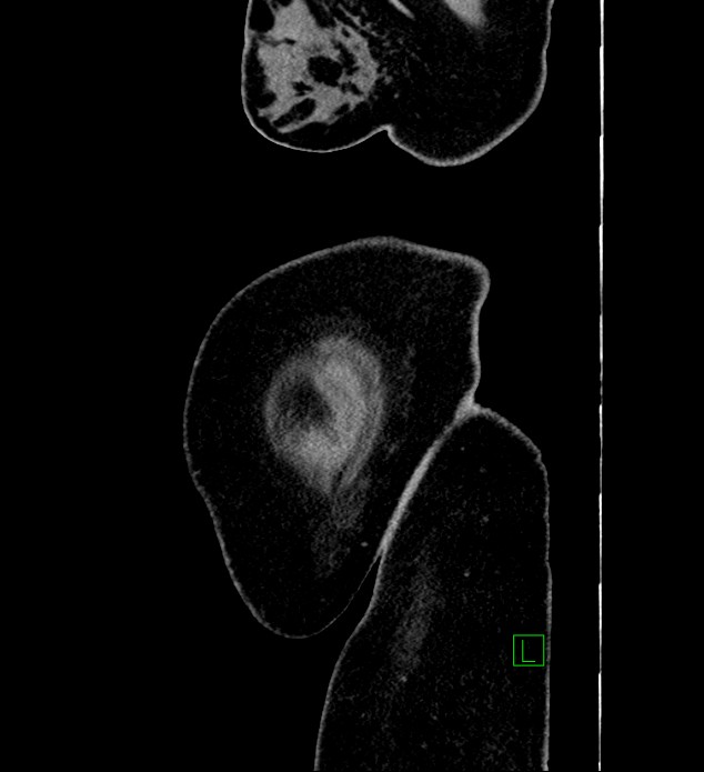 Chromophobe renal cell carcinoma (Radiopaedia 84239-99519 G 2).jpg