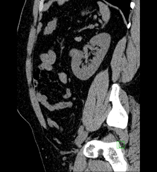 Chromophobe renal cell carcinoma (Radiopaedia 84286-99573 C 51).jpg