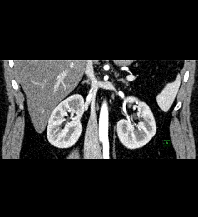 Chromophobe renal cell carcinoma (Radiopaedia 84286-99573 E 44).jpg