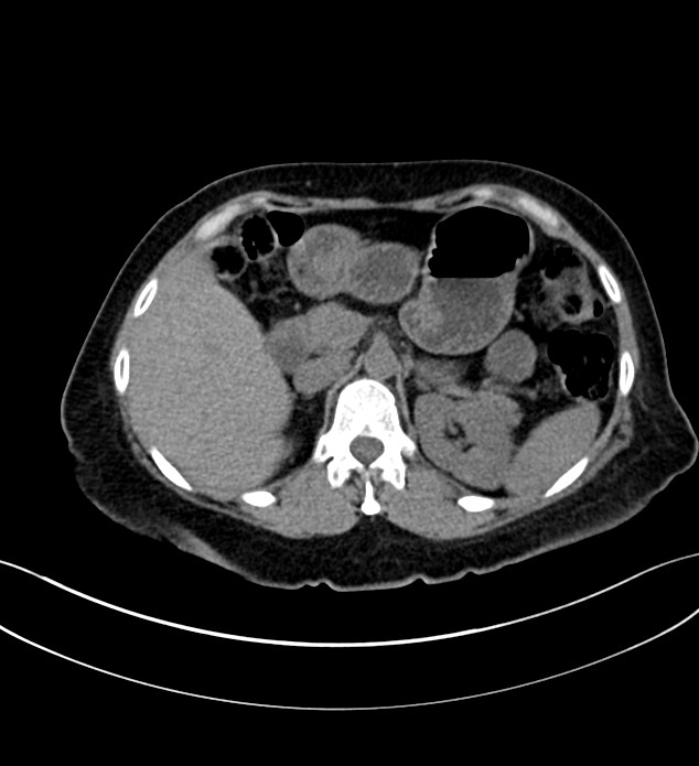 Chromophobe renal cell carcinoma (Radiopaedia 84290-99582 Axial non-contrast 45).jpg