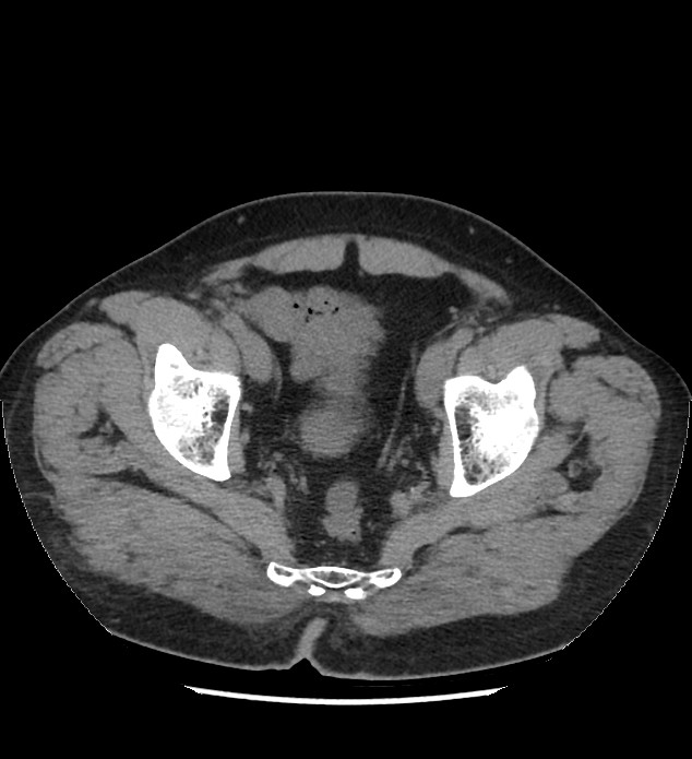 Chromophobe renal cell carcinoma (Radiopaedia 86879-103083 Axial non-contrast 116).jpg