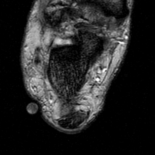File:Chronic Achilles tendon rupture (Radiopaedia 15262-15100 Axial Gradient Echo 20).jpg