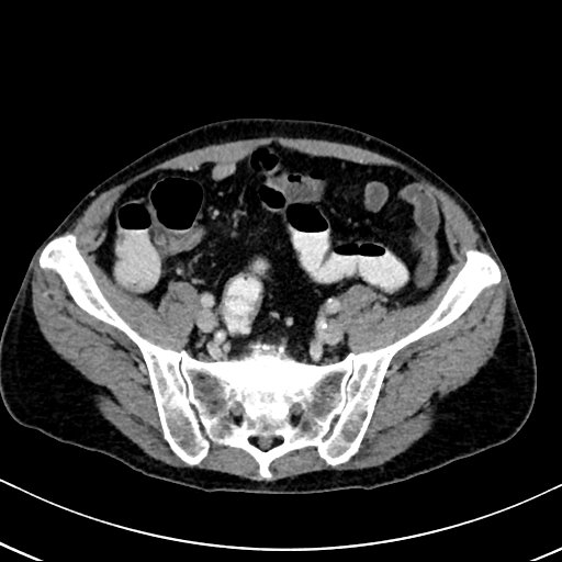 Chronic appendicitis complicated by appendicular abscess, pylephlebitis and liver abscess (Radiopaedia 54483-60700 B 112).jpg