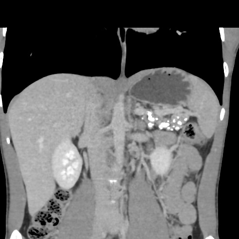 File:Chronic calcific pancreatitis (Radiopaedia 56280-62953 F 14).jpg