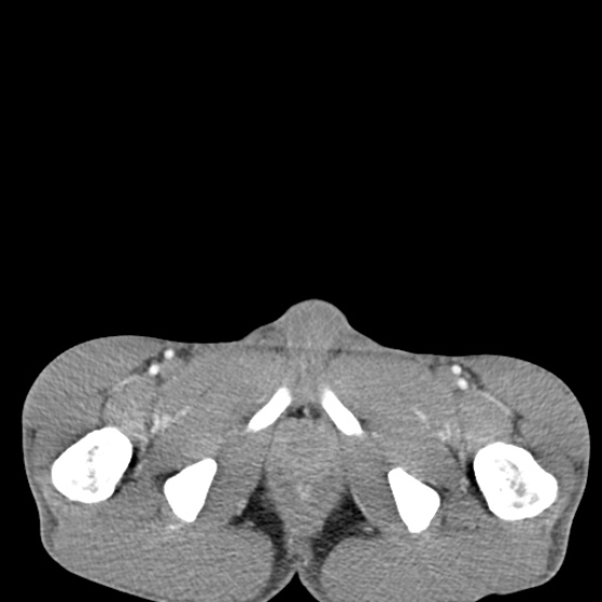 Chronic large bowel pseudo-obstruction (Radiopaedia 43181-46492 A 167).jpg