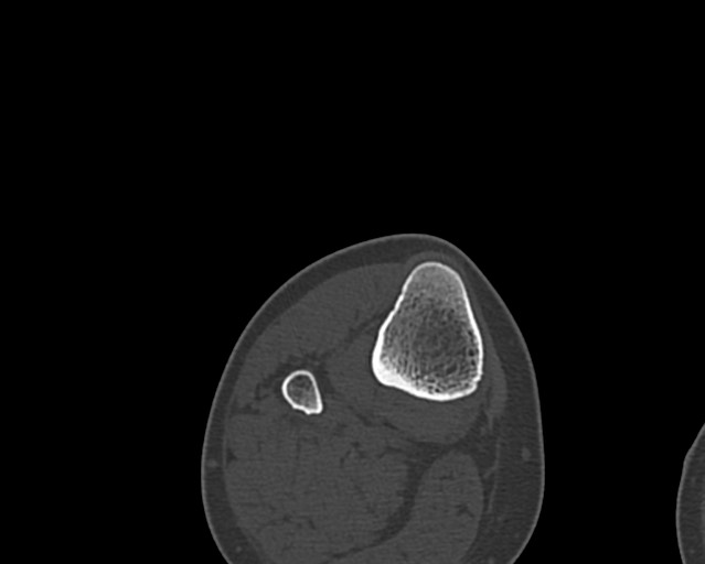 File:Chronic ostemyelitis of the femur with long sinus tract (Radiopaedia 74947-85982 Axial bone window 256).jpg