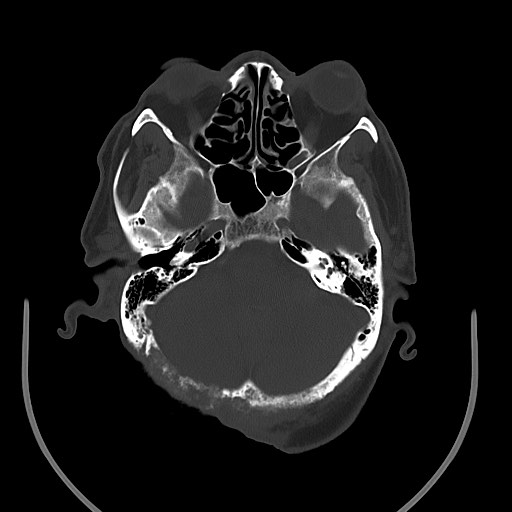 Chronic osteomyelitis - calvarial (severe) (Radiopaedia 69668-79616 Axial bone window 32).jpg