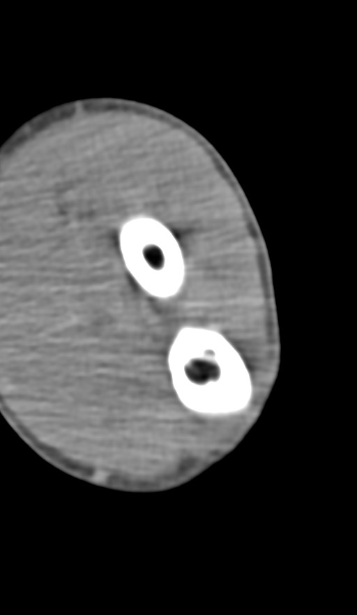 Chronic osteomyelitis of the distal humerus (Radiopaedia 78351-90971 Axial non-contrast 116).jpg