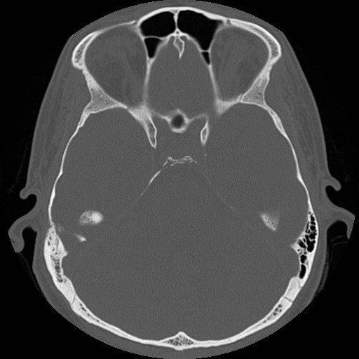 File:Chronic otomastoiditis (Radiopaedia 27138-27309 Axial bone window 50).jpg