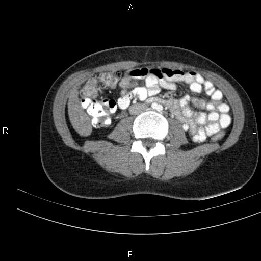Chronic pancreatitis (Radiopaedia 64576-73450 B 92).jpg